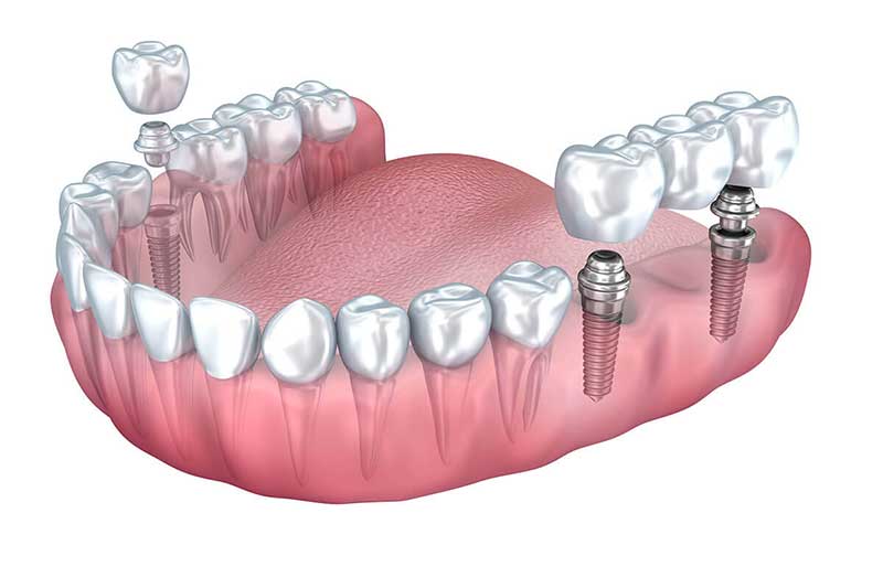 dentistiya izmir -diş laboratuvarı-kopru-dis