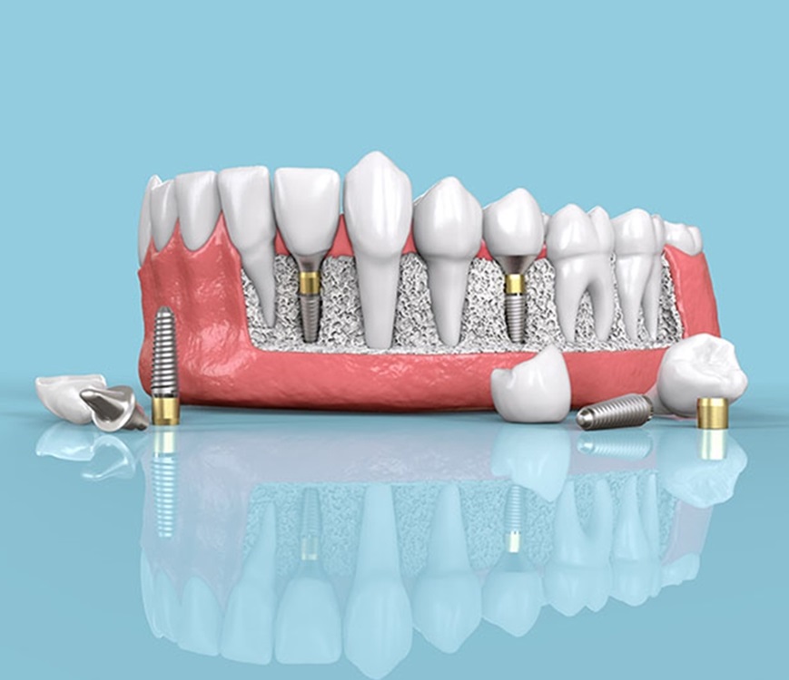 dentistiya-diş-laboraruvarı-izmir-dis-implant